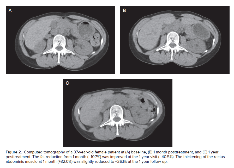 Aesthetic Surgery Journal EMSculpt Computed Tomography at Baseline - 1 month - 1 year