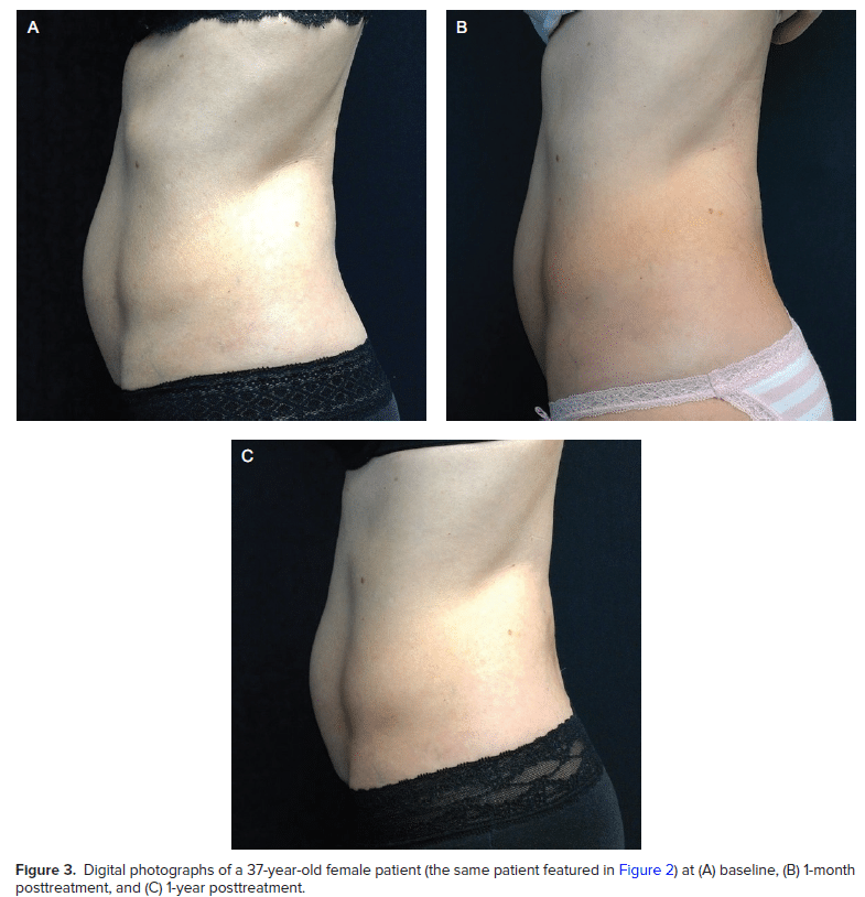 Aesthetic Surgery Journal EMSculpt Results at Baseline - 1 month - 1 year