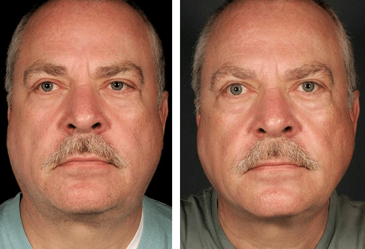 Before_and_After_Thermage_6_Months_Male