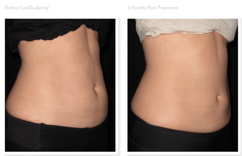 Coolsculpting Before & After