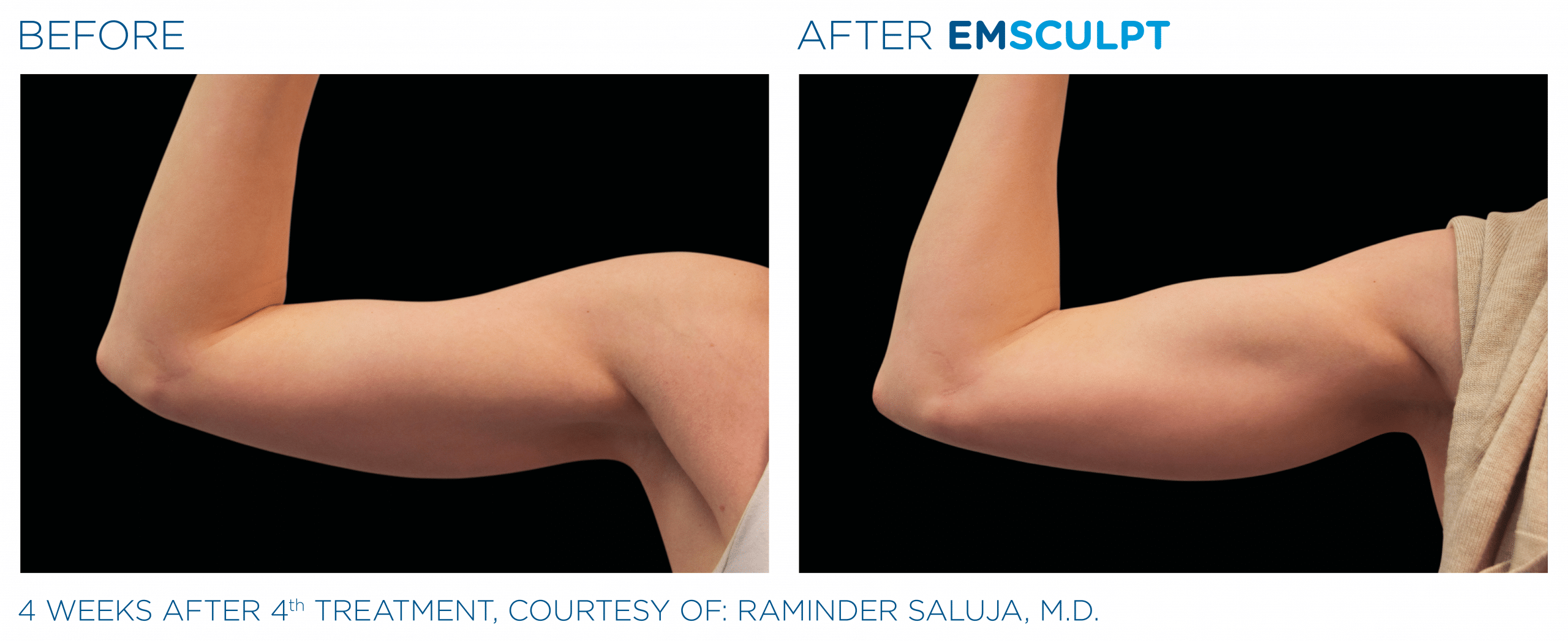 EMSCULPT_Biceps