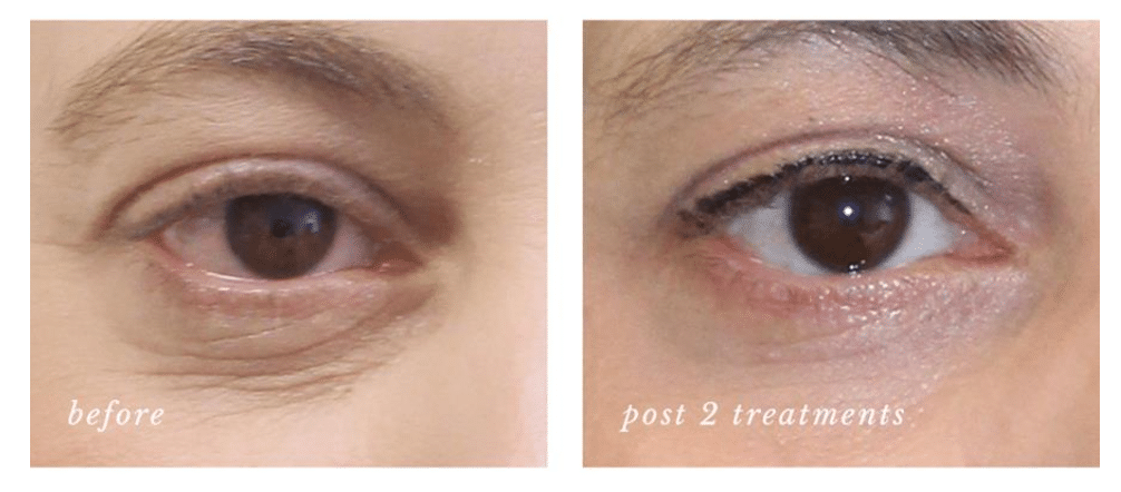 PRP Tear Trough B&A