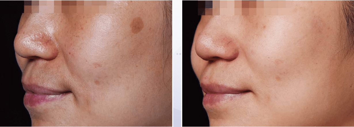 PicoWay_Before&After_2 Treatments