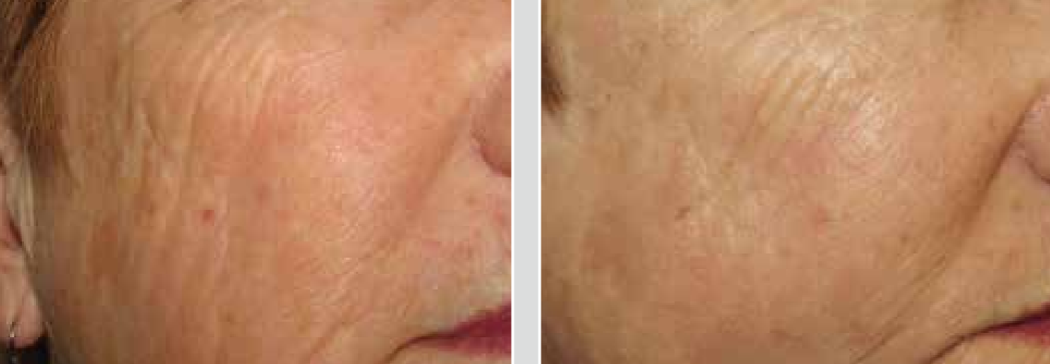 PicoWay_Before&After_2 Treatments