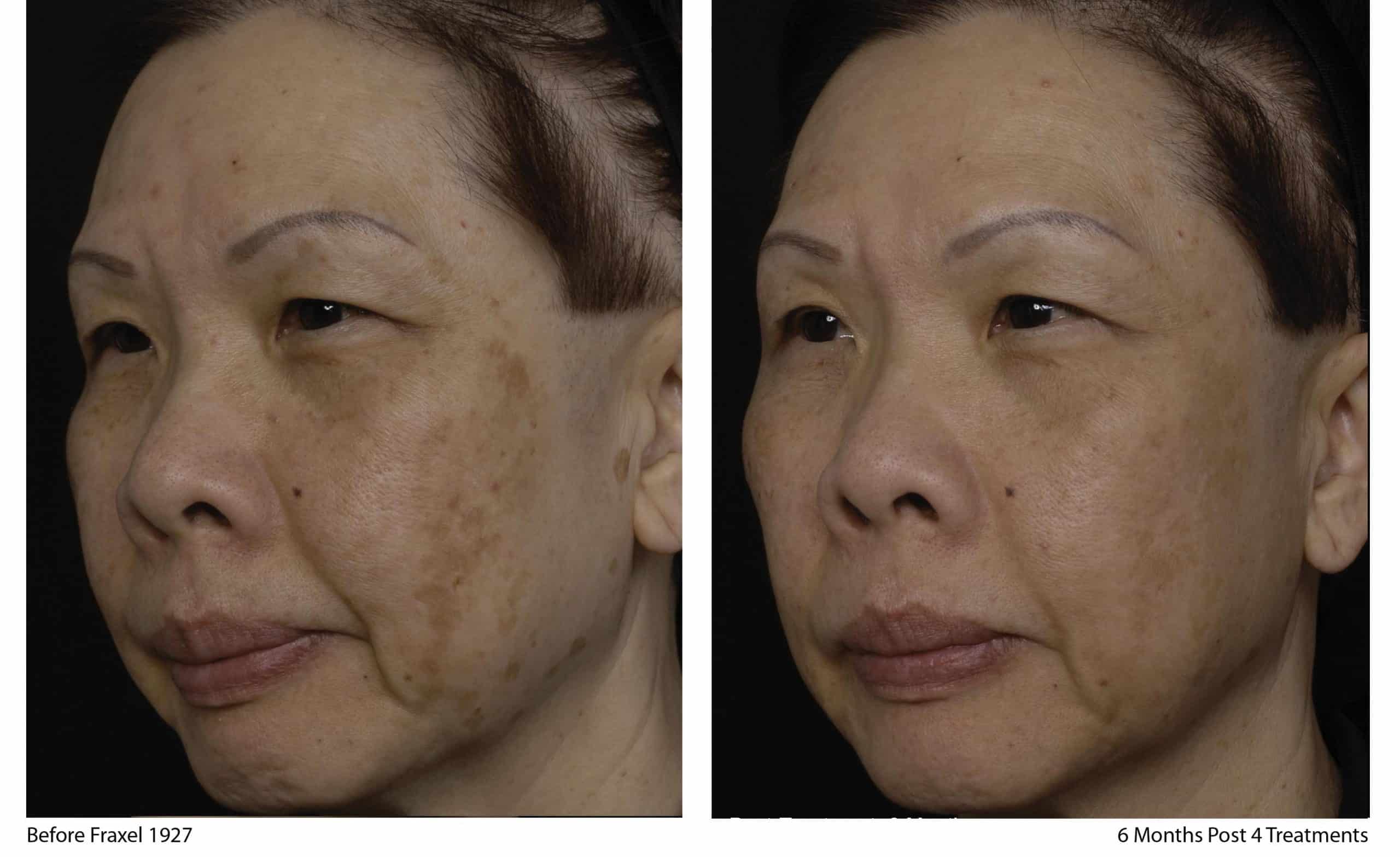Project Skin Vancouver Fraxel Restore Before After