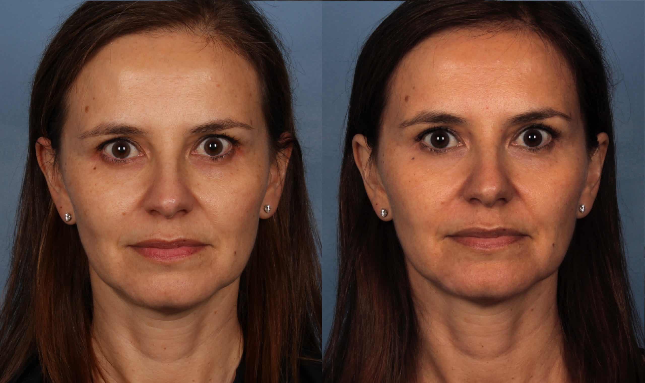 Project Skin Clear and Brilliant Before & After 1