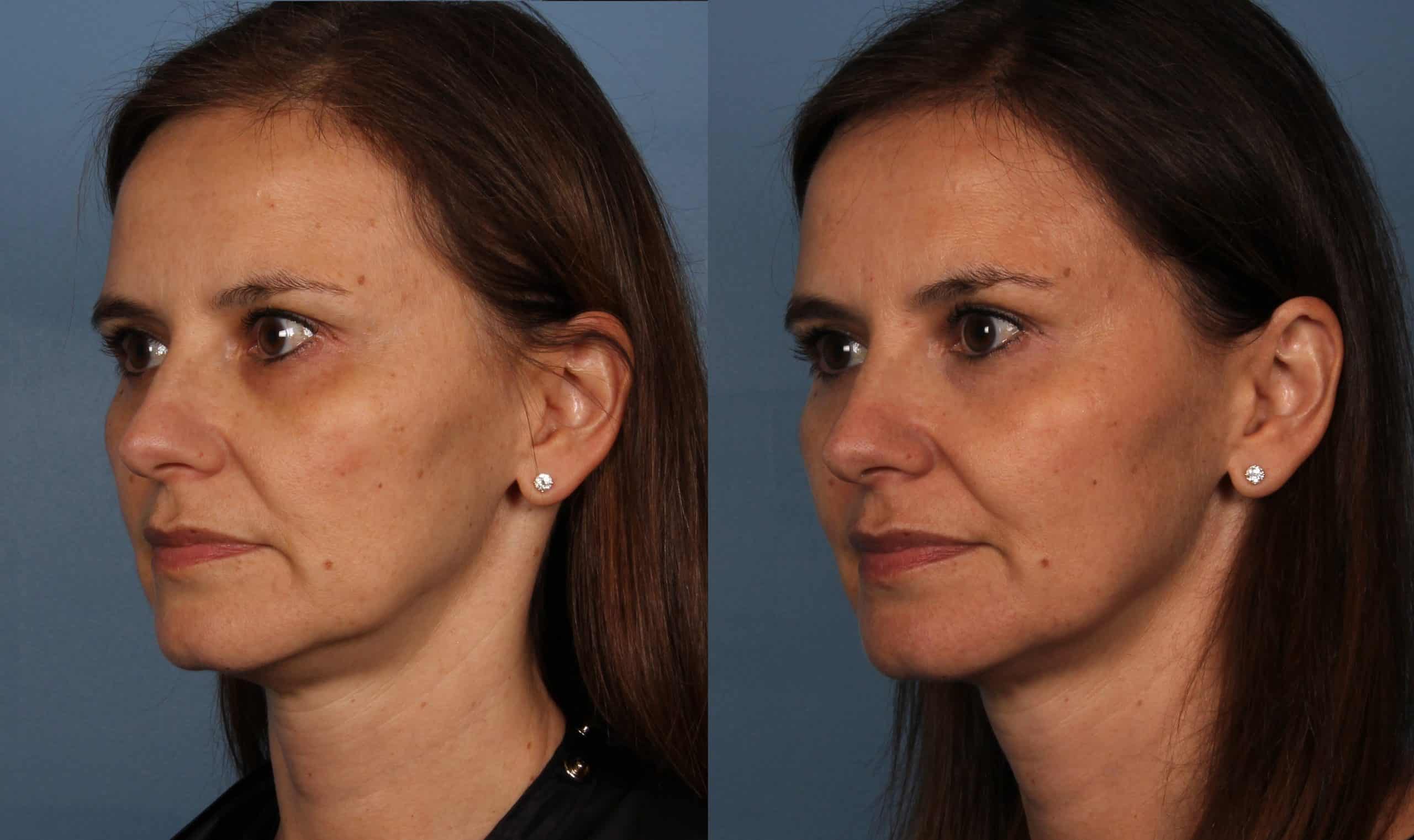 Project Skin Clear and Brilliant Before & After 2