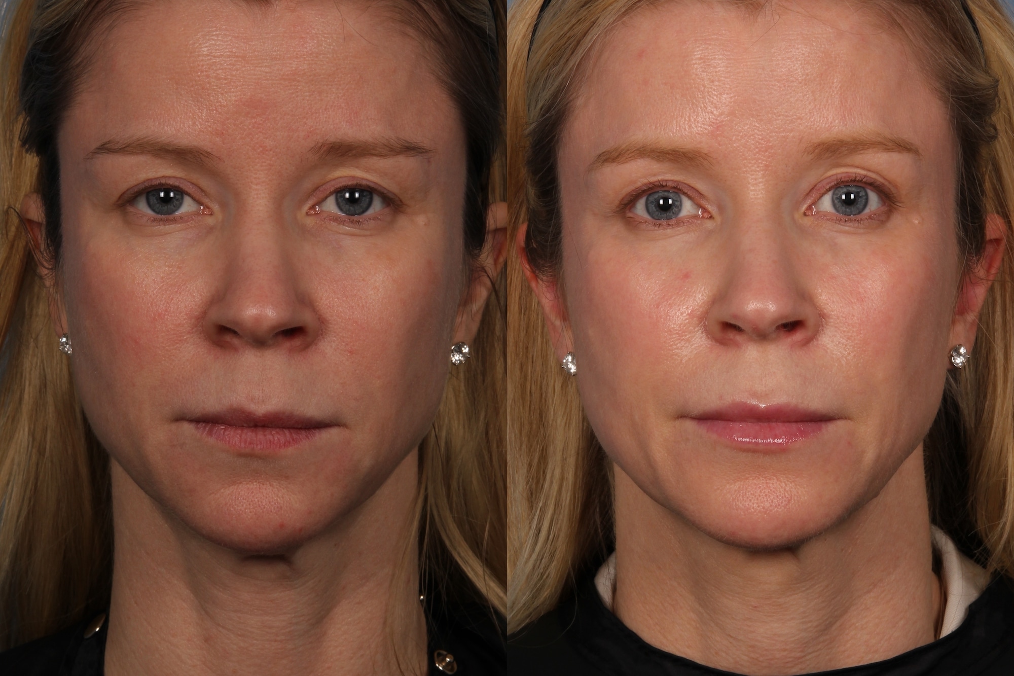 Project Skin Clear and Brilliant Before and After 3