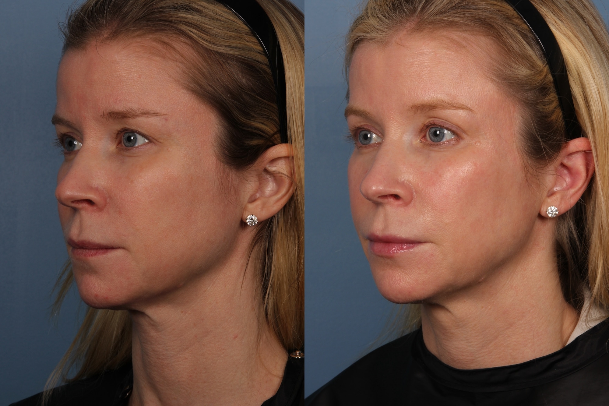 Project Skin Clear and Brilliant Before and After