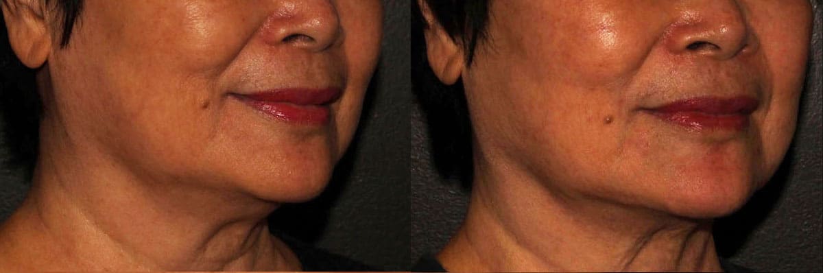 Project Skin Jacky Lo Jawline Filler Before After 2