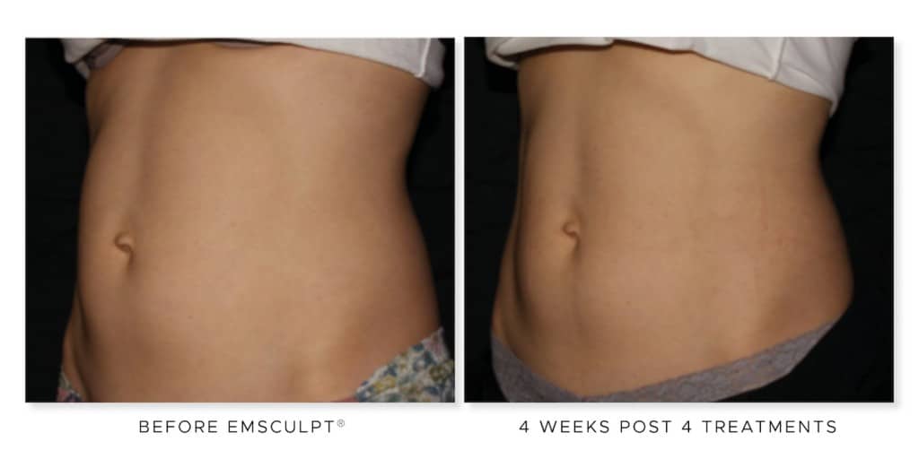 Project-Skin-MD-Vanessa-EMSculpt-Before-and-After