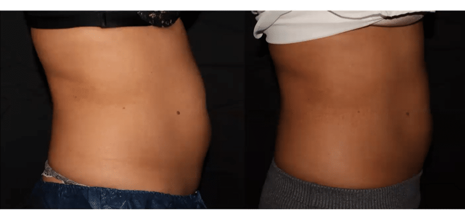 Project Skin MD Steph Coolsculpting Before & After
