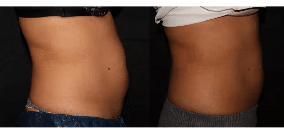 Tailored Body Contouring Treatments with Coolsculpting - Project Skin MD