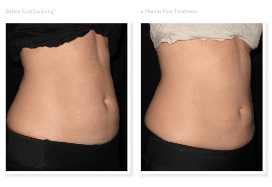 Project Skin MD Vancouver Coolsculpting Before & After