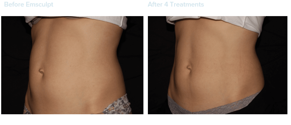 Project Skin MD Vancouver EMSculpt Body Before & After