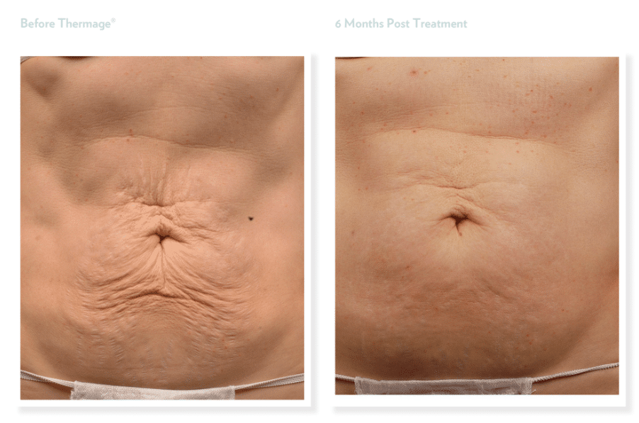 Project Skin MD Vancouver Thermage Body Before & After