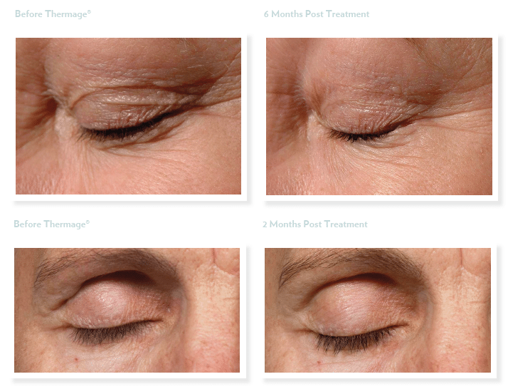 Project Skin MD Vancouver Thermage Eye Before & After