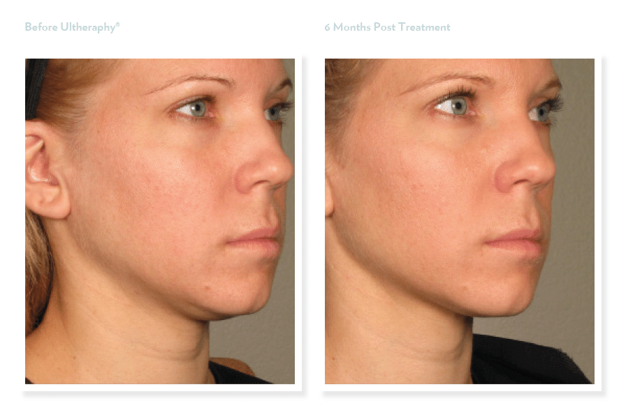 Project Skin MD Vancouver Ultherapy Face and Neck Before & After