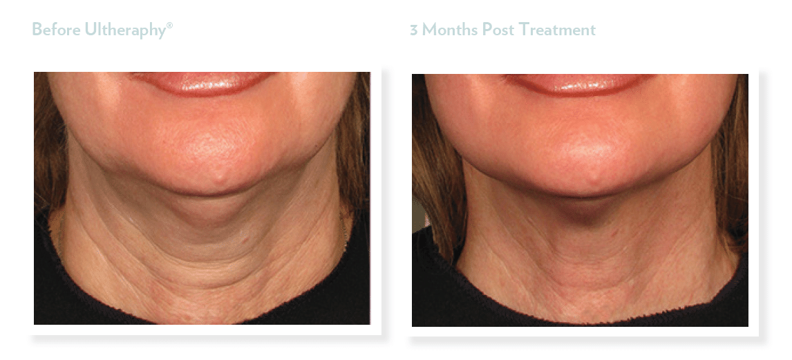 Project Skin MD Vancouver Ultherapy Neck Before & After
