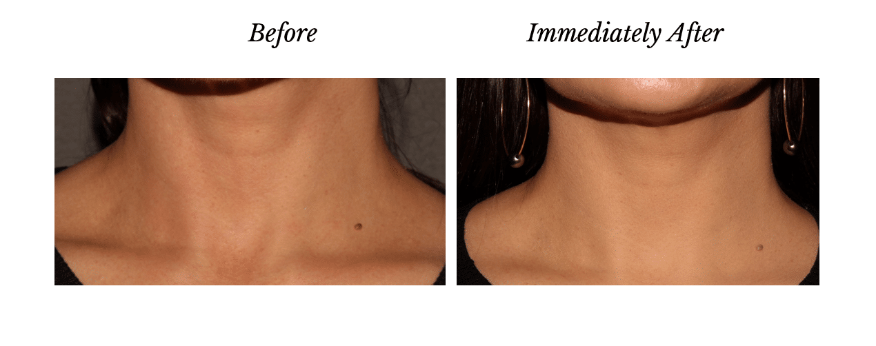 Project Skin MD Vancouver Volite 1mL Before & After