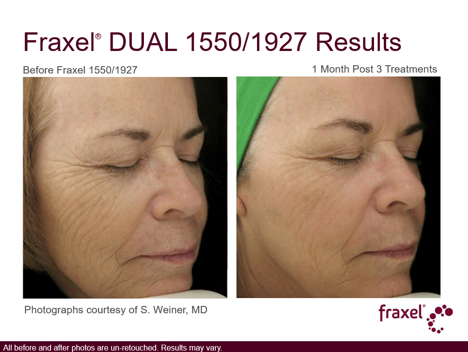 Project Skin MD Vancouver_Fraxel_1550 and 1927_3 Treatments