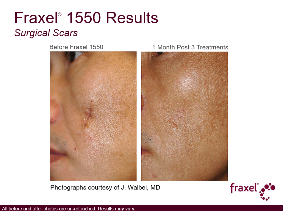 Project Skin MD Vancouver_Fraxel_1550_3 Treatments