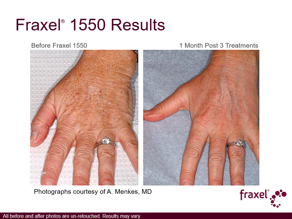 Project Skin MD Vancouver_Fraxel_1550_3 Treatments_Hands