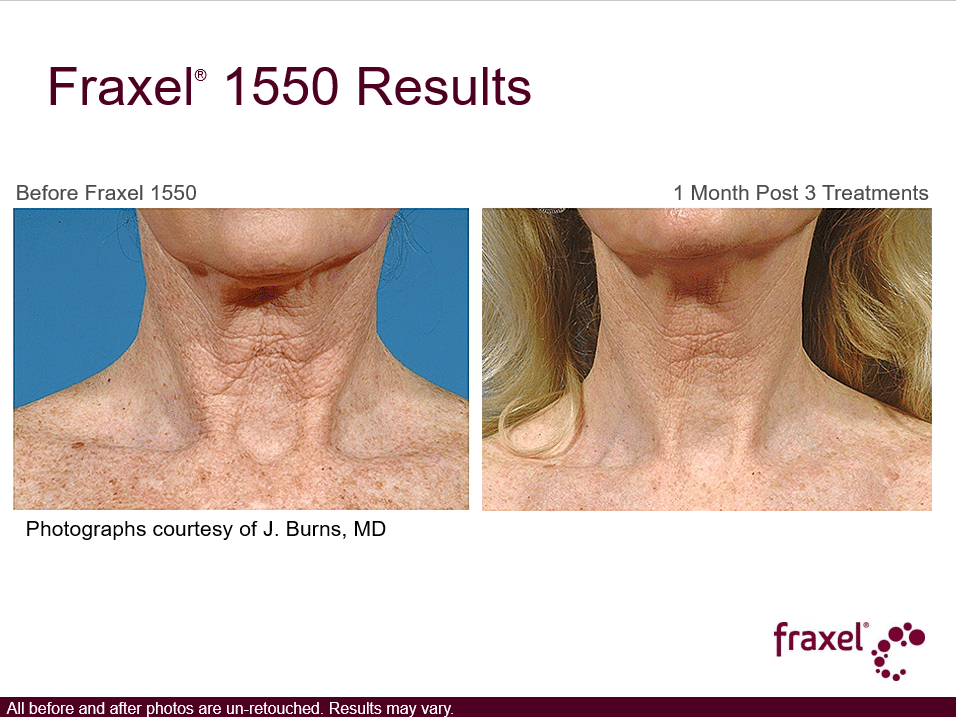 Project Skin MD Vancouver_Fraxel_1550_3 Treatments_Neck
