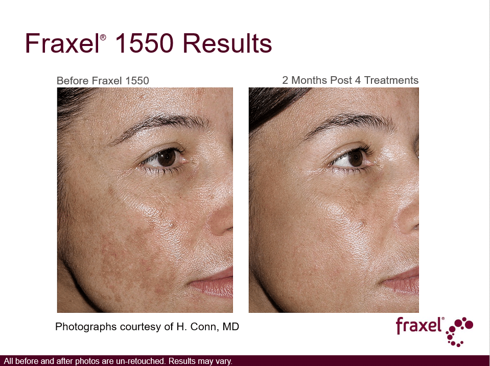 Project Skin MD Vancouver_Fraxel_1550_4 Treatments_2