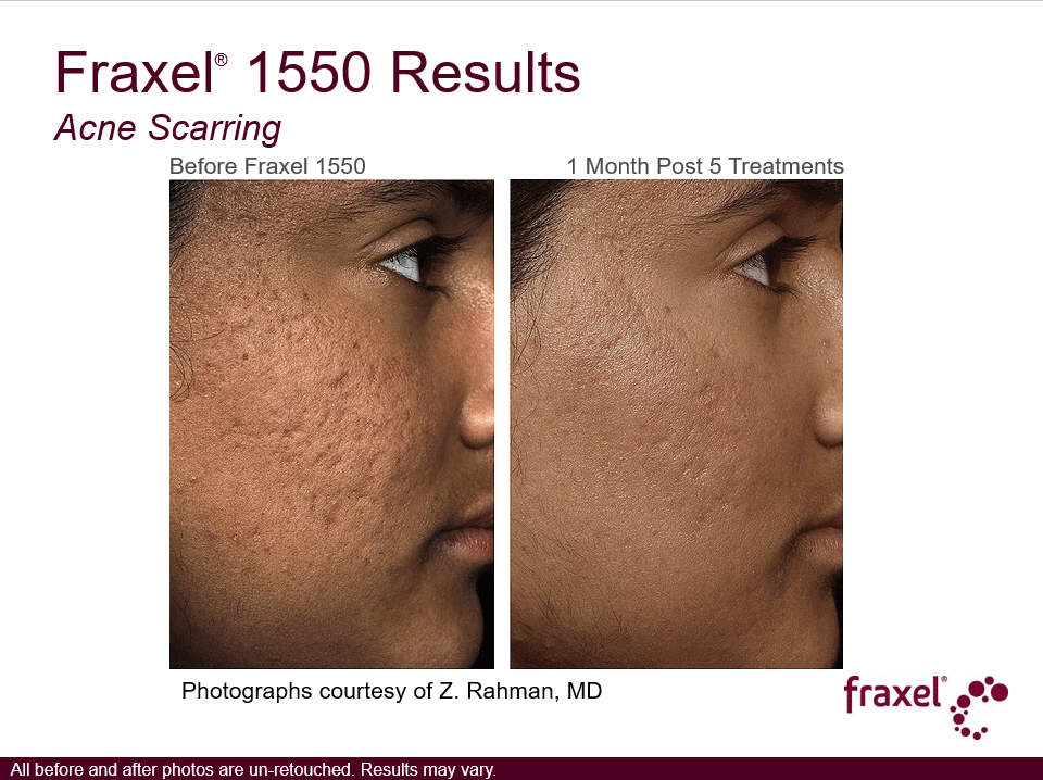 Project Skin MD Vancouver_Fraxel_1550_5 Treatments