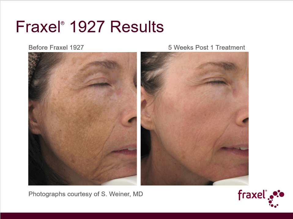 Project Skin MD Vancouver_Fraxel_1927_1 Treatment