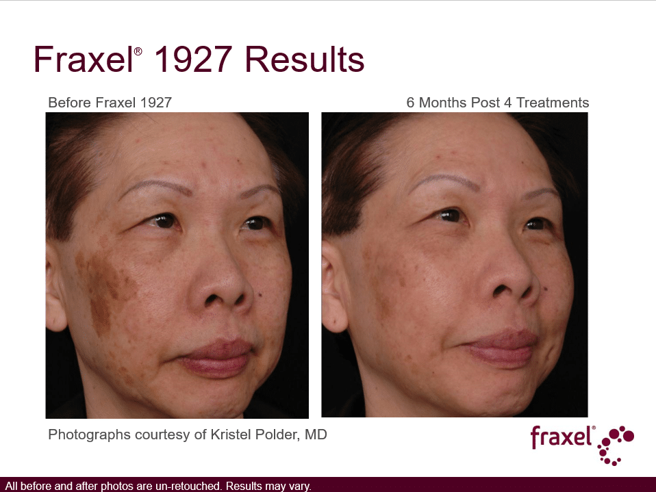 Project Skin MD Vancouver_Fraxel_1927_4 Treatments