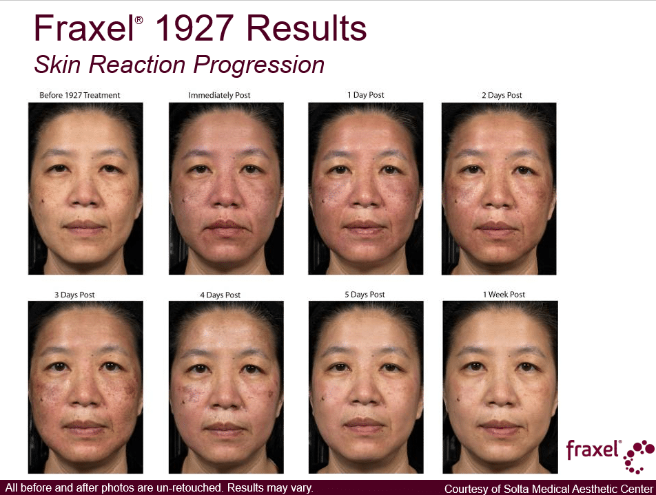 Project Skin MD Vancouver_Fraxel_1927_Skin Reaction Progression