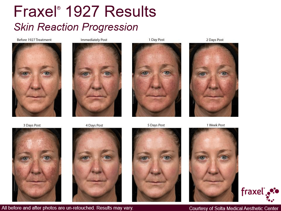 Project Skin MD Vancouver_Fraxel_1927_Skin Reaction Progression_1