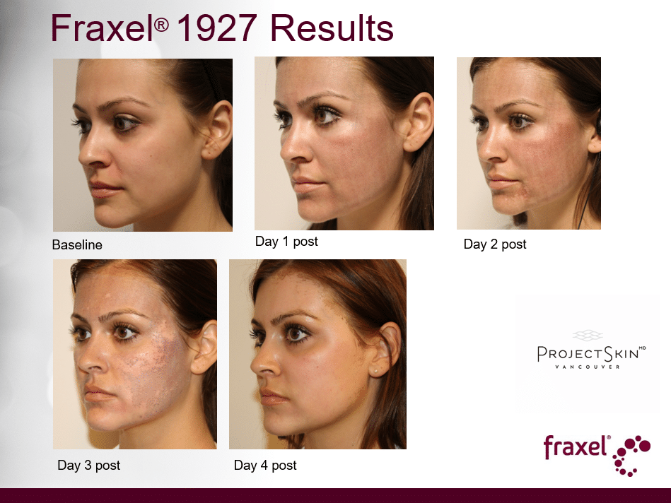 Project Skin MD Vancouver_Fraxel_1927_Skin Reaction Progression_3