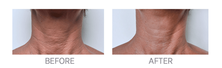 Project Skin MD Vancouver_Redensity I_Neck