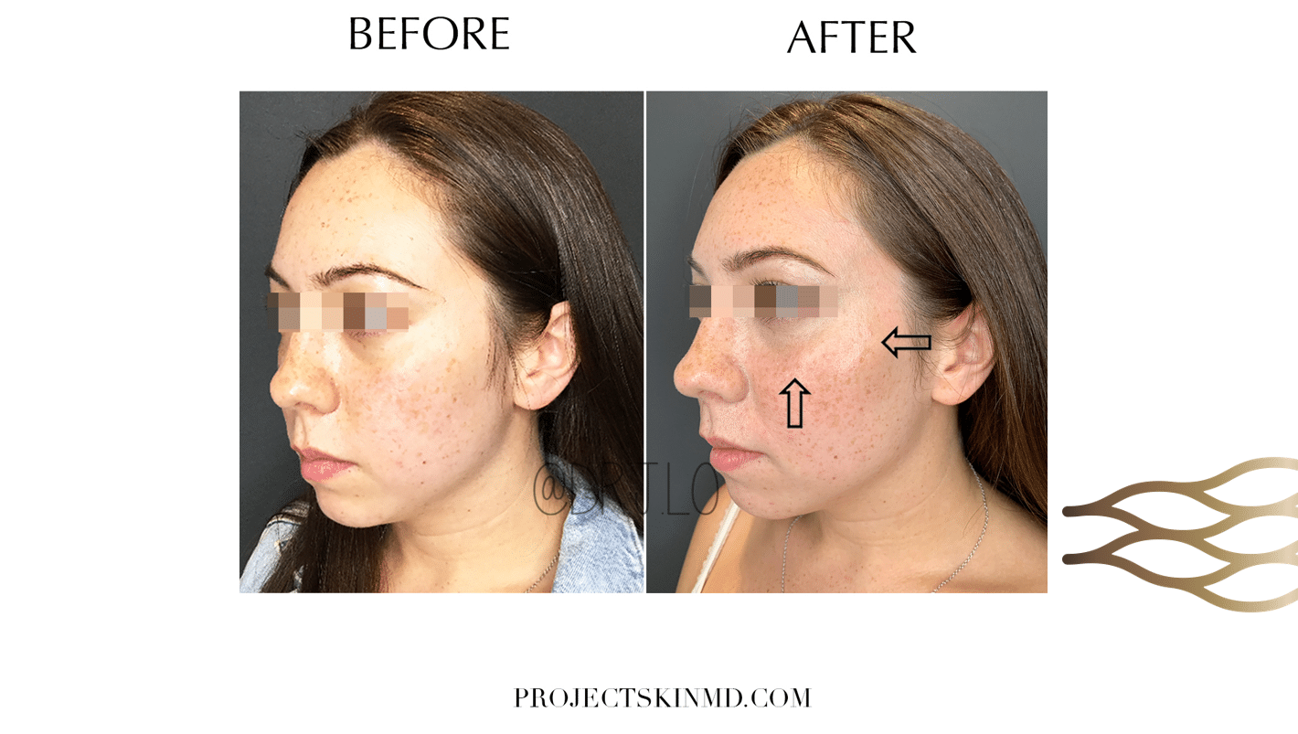 Project Skin MD Dr Jacky Lo Cheek Augmentation