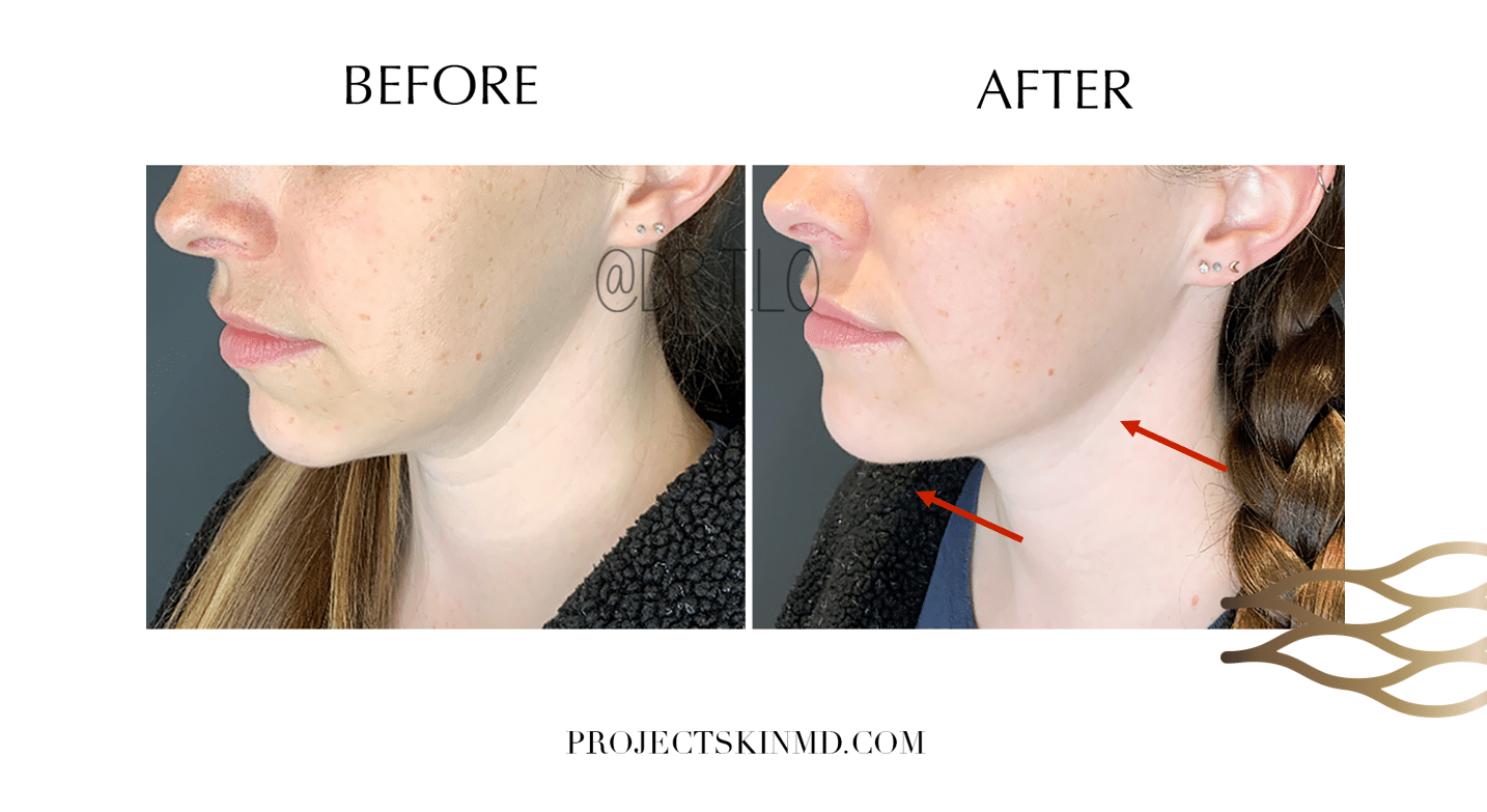 Project Skin MD Dr Jacky-Lo Lower Face Contouring