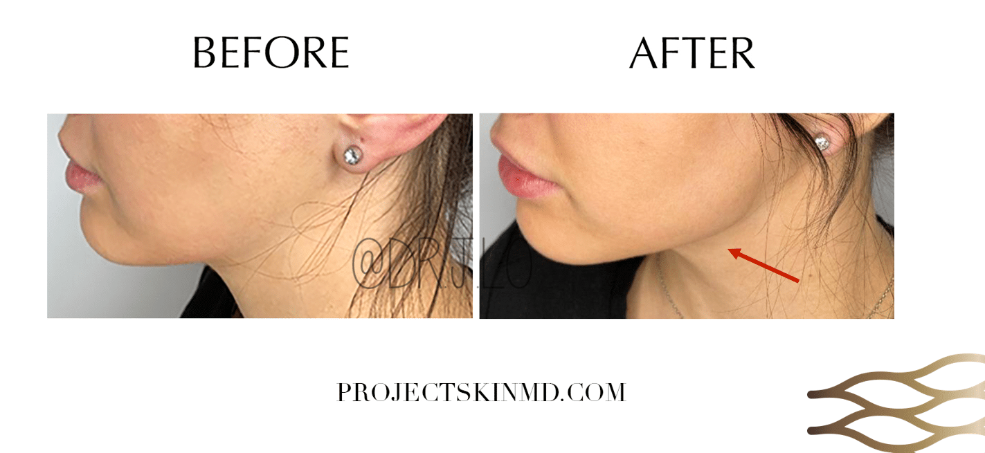 Project Skin MD Dr Jacky Lo Lower Face Contouring 2
