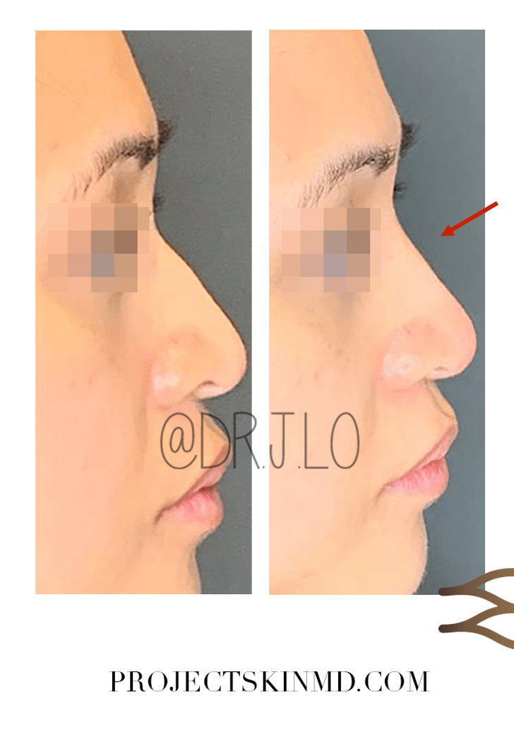 Project Skin MD Dr Jacky Lo Non Surgical Nose Job