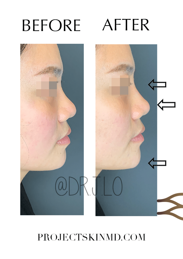 Project Skin MD Dr Jacky Lo Non Surgical Nose Job 2