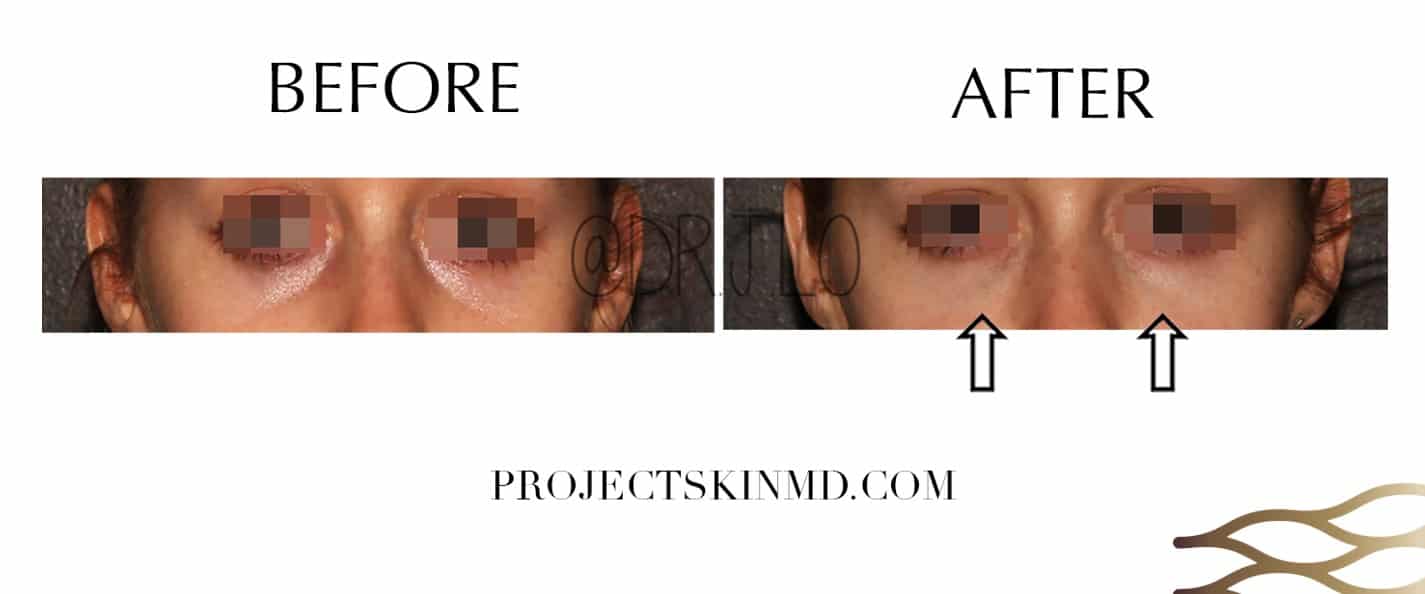 Project Skin MD Dr Jacky Lo Tear Trough