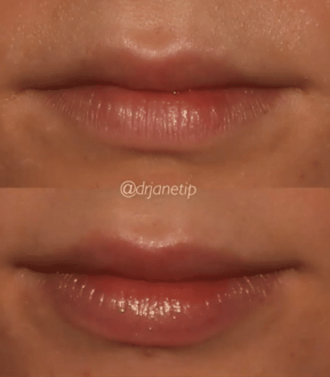 Project Skin MD_Dr Janet Ip_Lip Filler