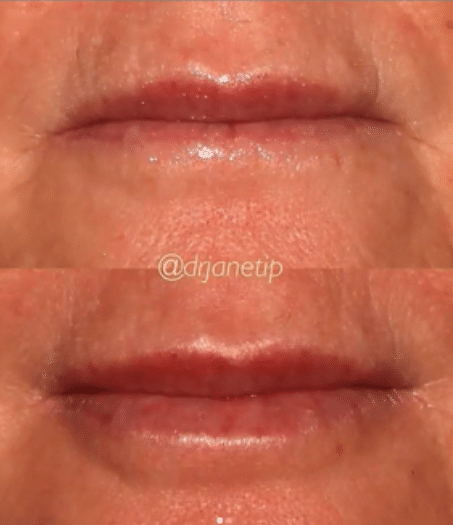 Project Skin MD_Dr Janet Ip_Lip Filler_2