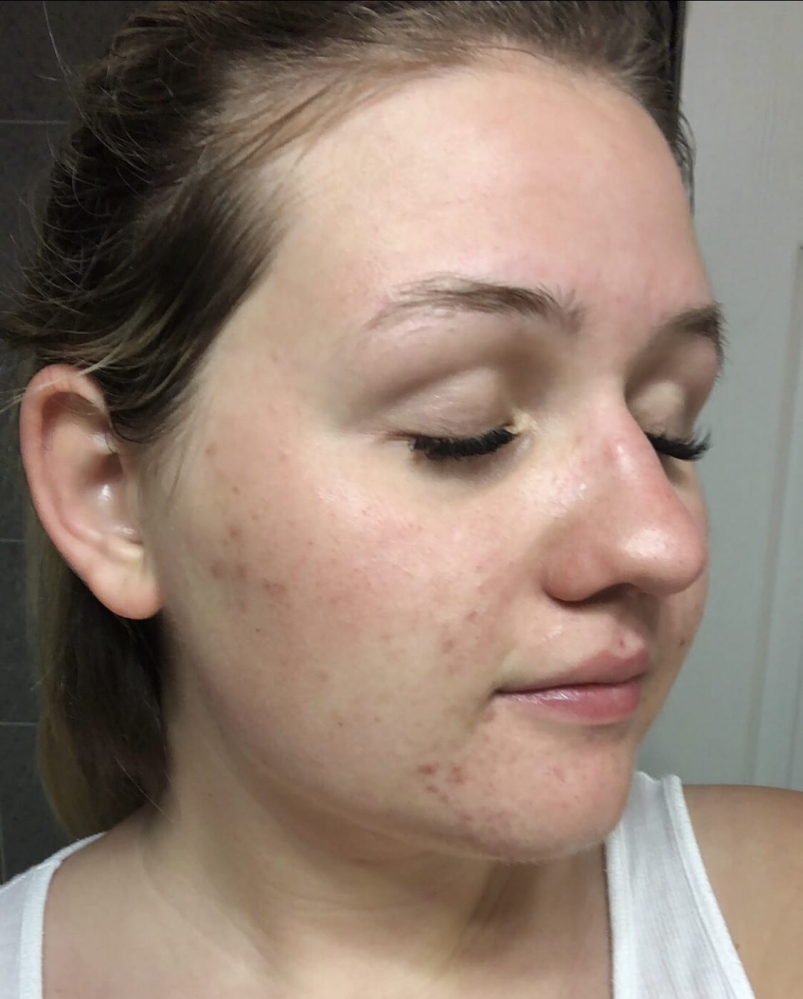 Project Skin Vancouver Acne VBeam Before After 2018