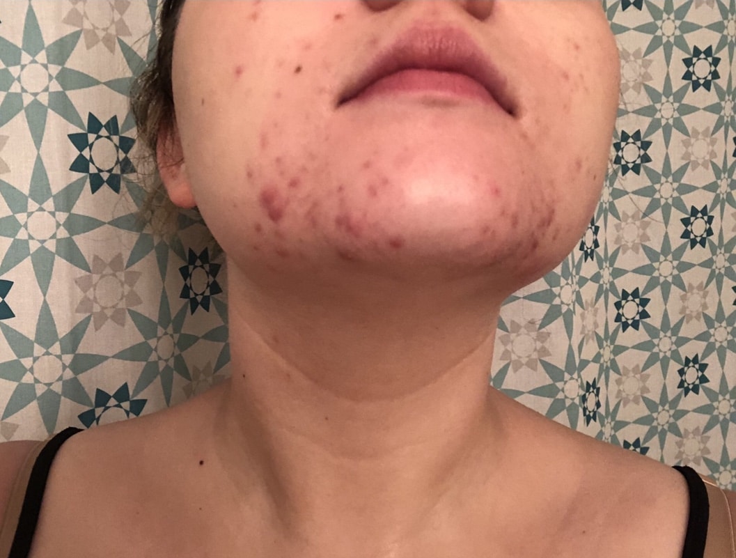 Project Skin Vancouver Acne VBeam Before After 2019 #2