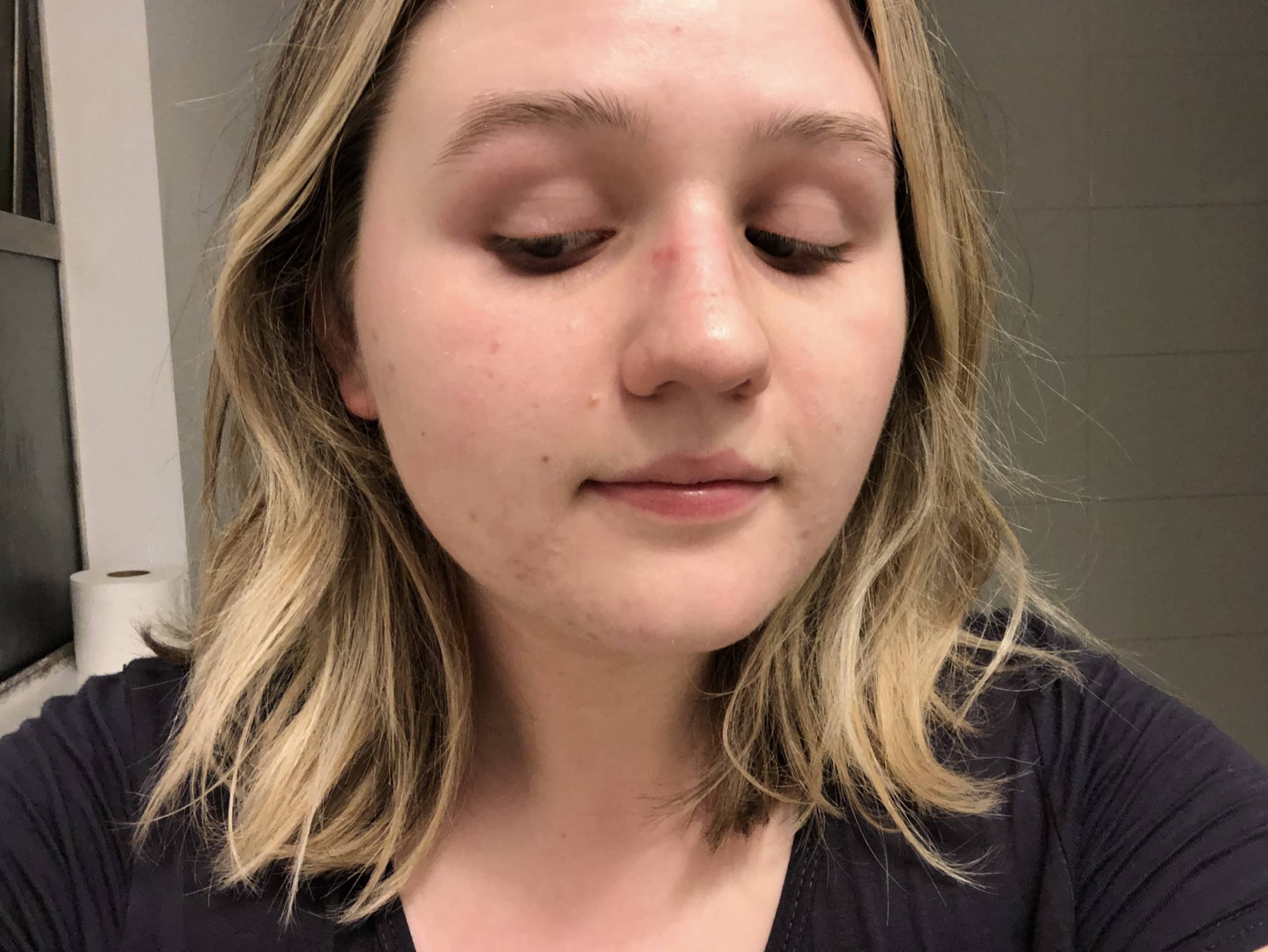 Project Skin Vancouver Acne VBeam Before After Current #1