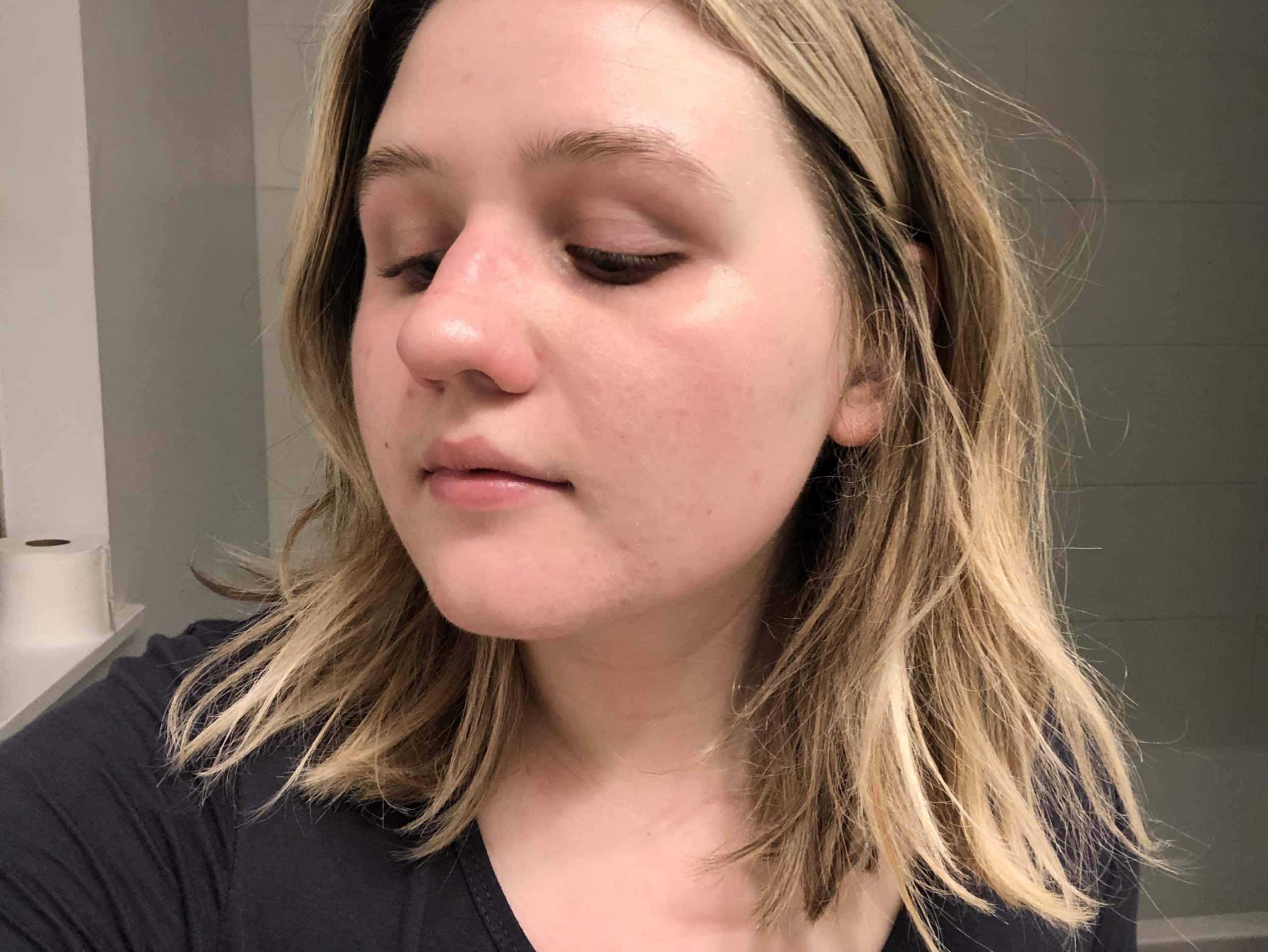 Project Skin Vancouver Acne VBeam Before After Current #2