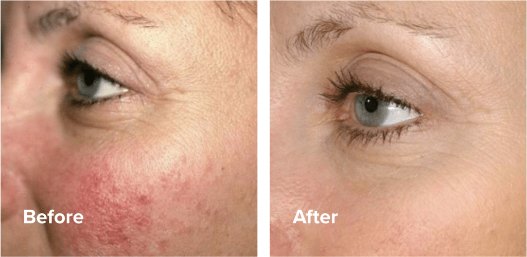 Retinol rosacea deals