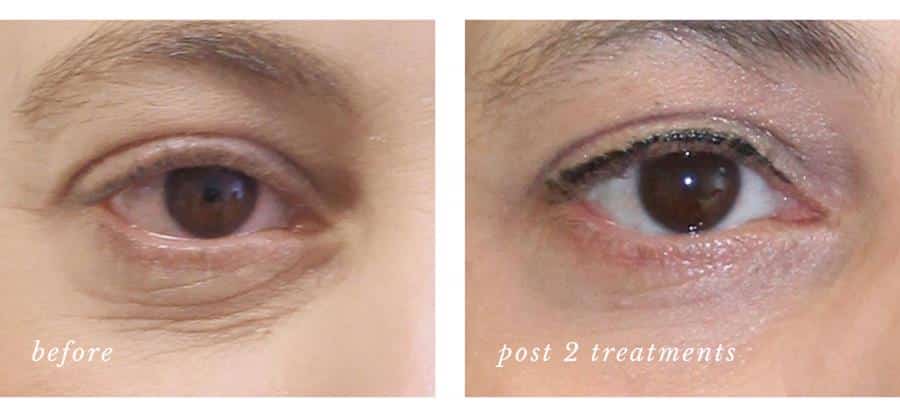 Project Skin Vancouver PRP Eyes Before After